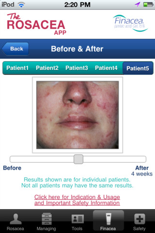 The Rosacea App for iPhone
