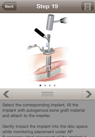 DePuy Spine MIS Lateral Interbody Fusion