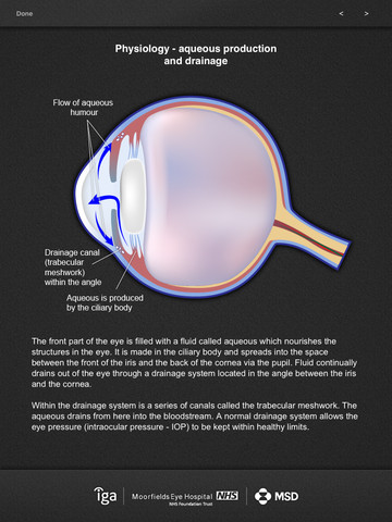 Glaucoma SIM for iPad