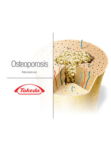 Osteoporosis for iPad