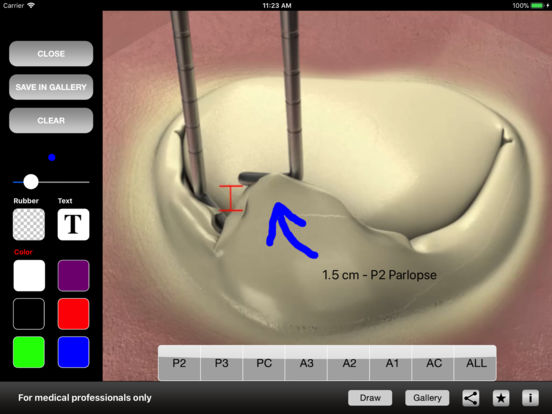 HEART MASTER Mitral & Tricuspid Valves for iPad