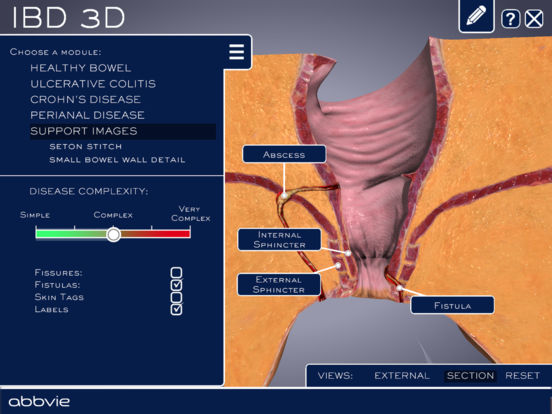 AbbVie IBD 3D for iPad