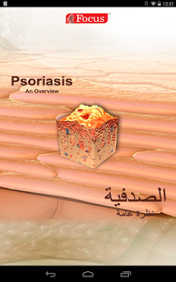 Psoriasis - An Overview