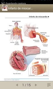 Síndrome Coronario Agudo