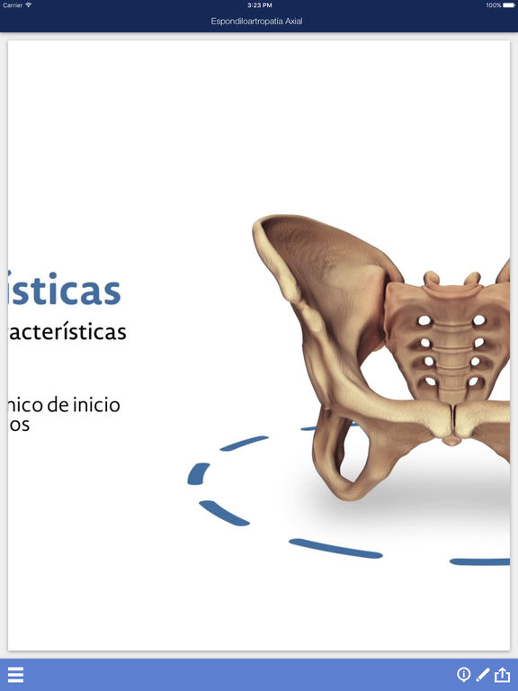 Atlas Espondiloartropatía Axial Abbvie for iPad