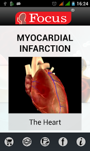Myocardial infarction.